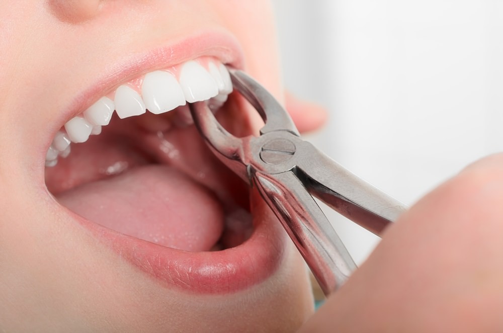 A lady having a tooth extracted with dental pliers