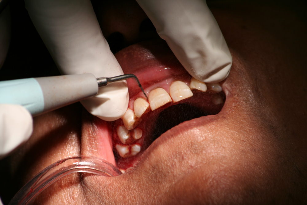 A dentist performing a dental scaling