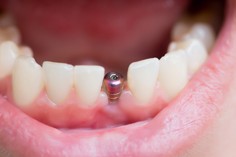 Dental implant costs Dental Aware