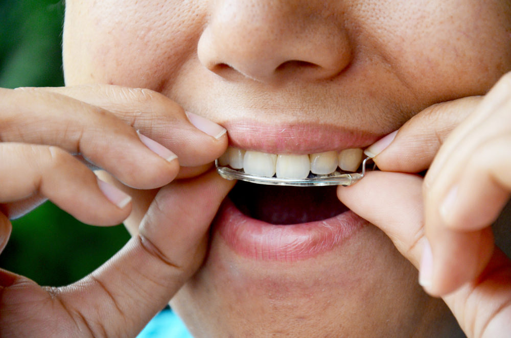 A lady with a removable dental plate