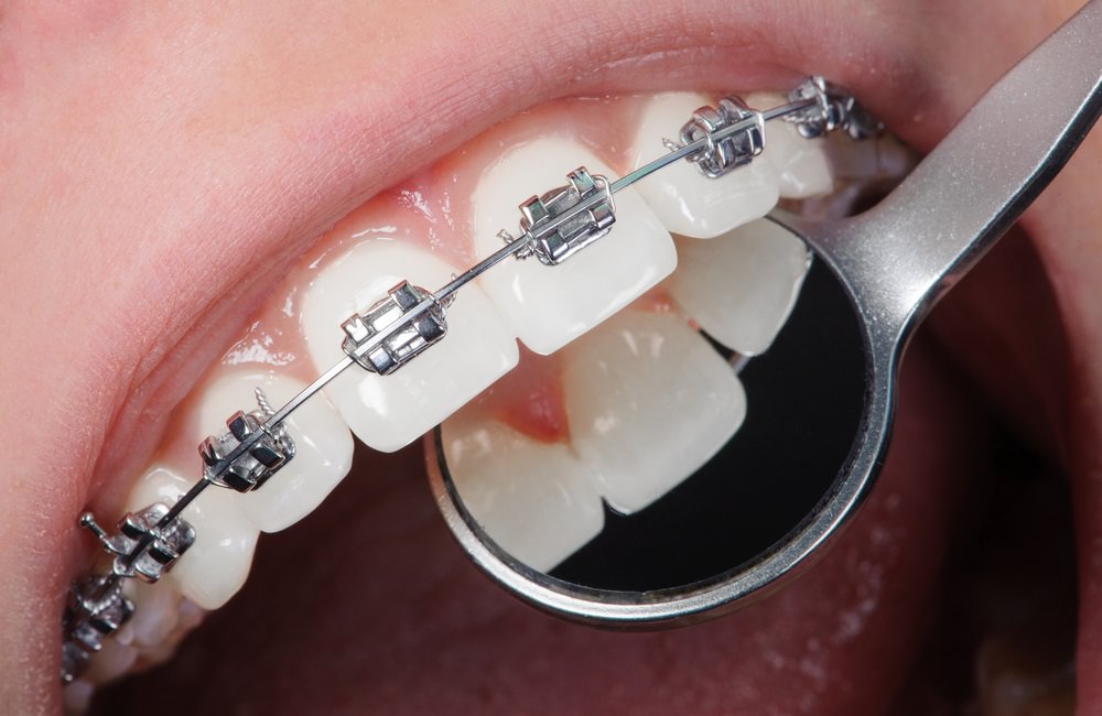 Traditional dental braces