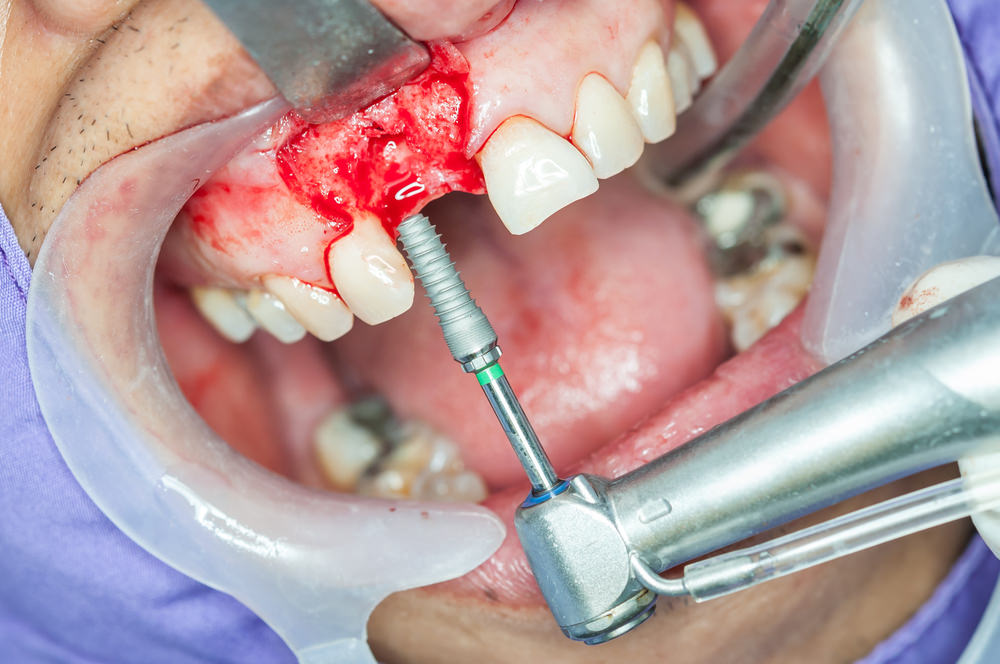 Dental implant screw going into a persons jaw