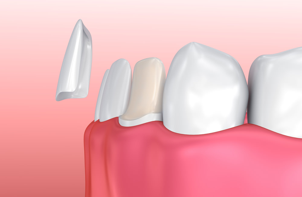 A 3D image of a Veneer - Some of the tooth is removed to make a perfect fit