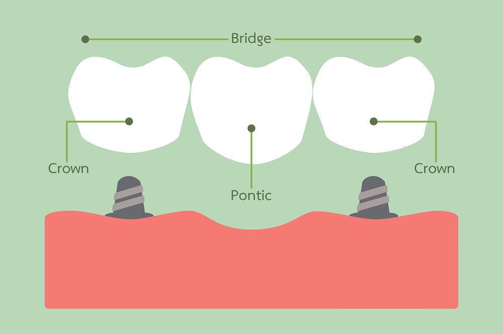 Illustration of a dental bridge