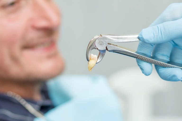 Tooth Extraction Cost How Much Should You Pay? Dental Aware Australia