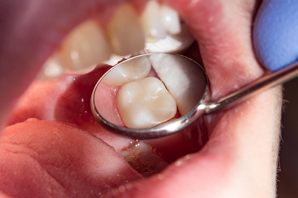 Dental Costs for fillings Feature image dental aware