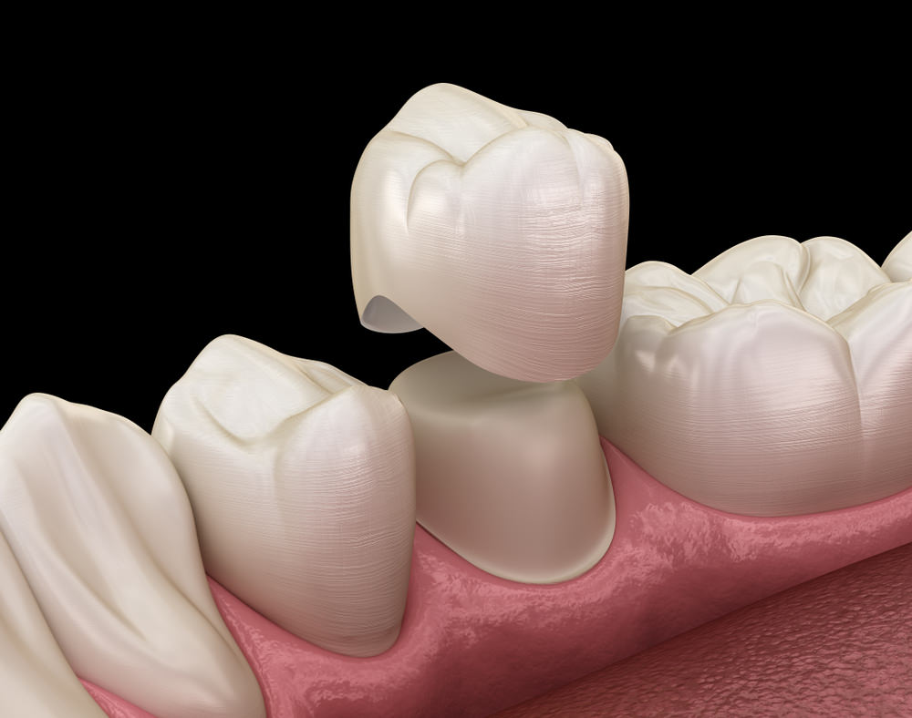 3d image of a dental crown