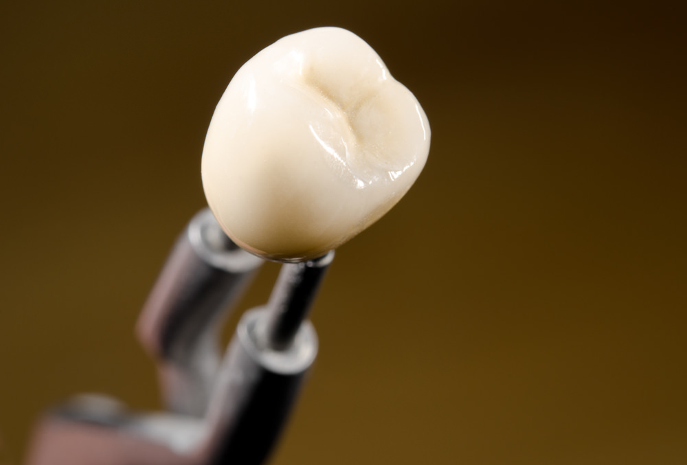 Dental costs for crowns feature image dental aware