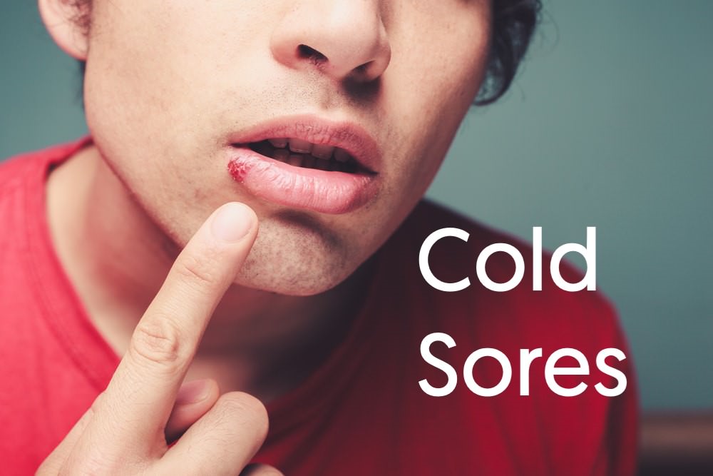 Cold sores feature dental aware