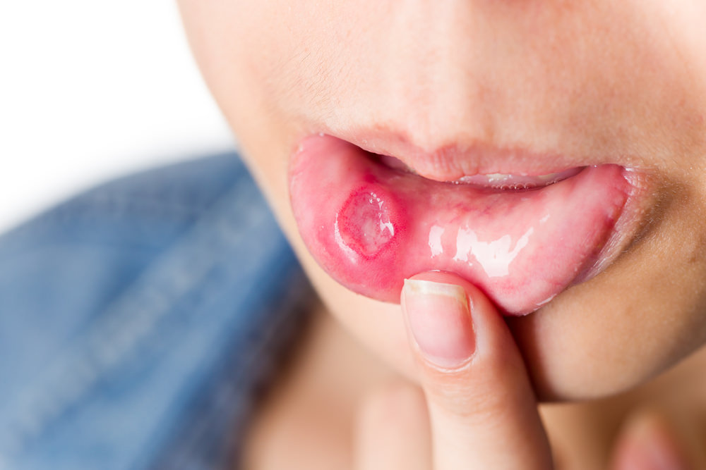 major mouth ulcer