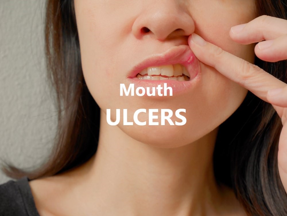 Mouth Ulcers feature image
