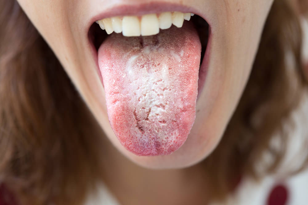 A lady with oral thrush