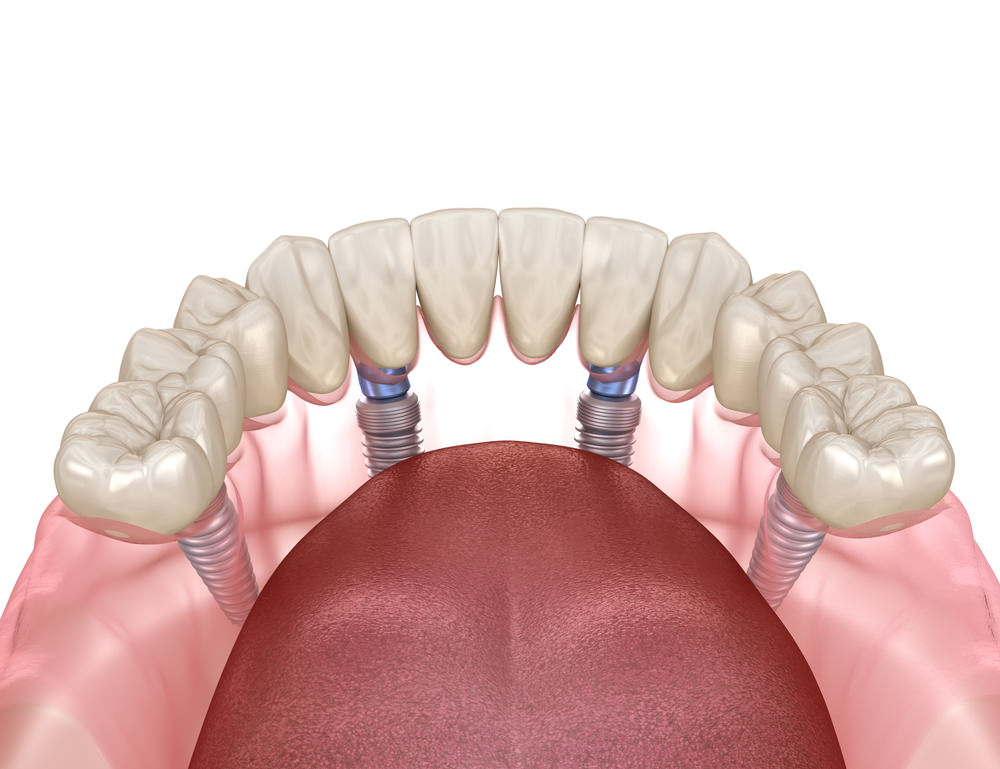 All on 4 dental implants