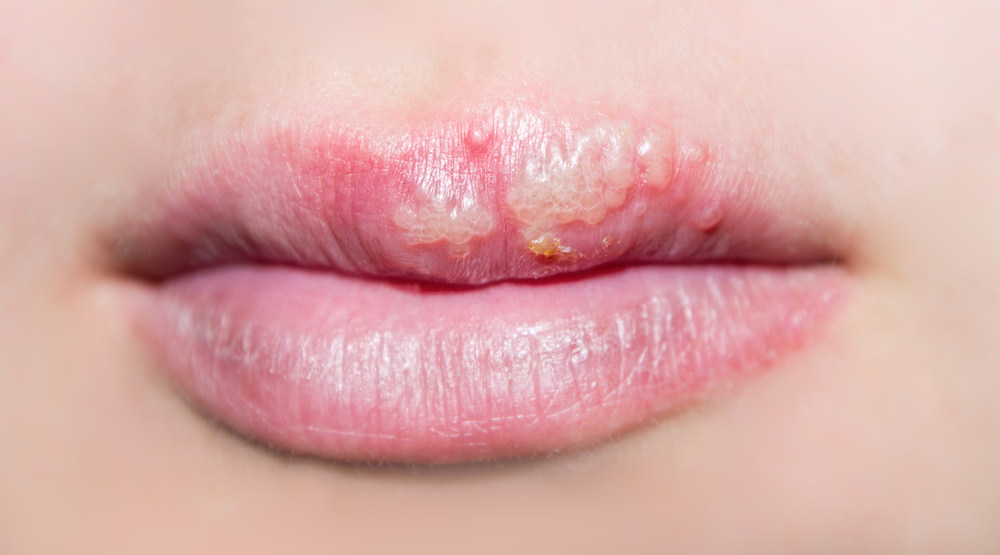 Cold sore cream feature image