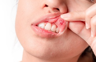 Cheap teeth whitening brisbane