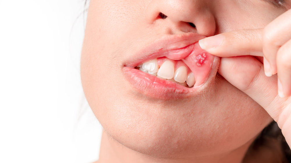 Mouth Ulcer won't healing feature image dental aware