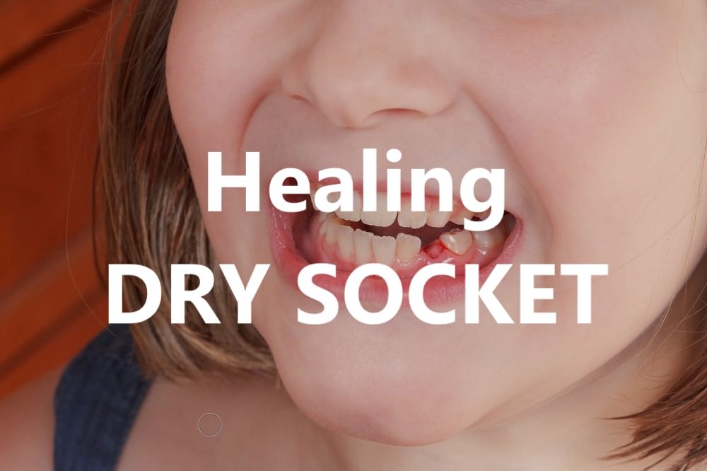 Healing dry socket feature dental aware