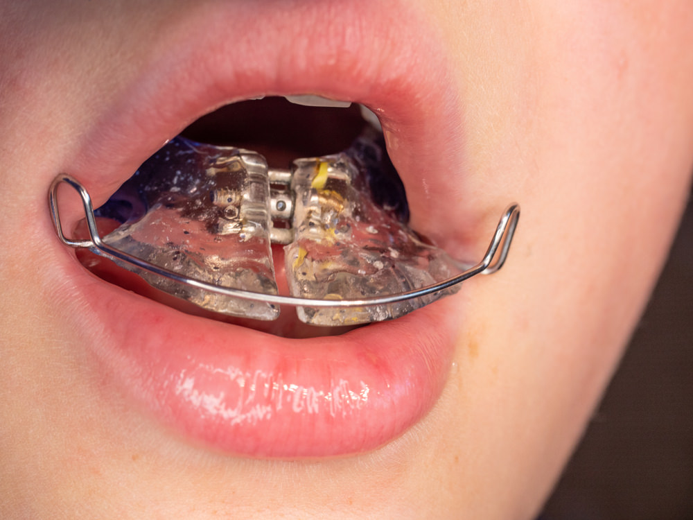 A person removing a retainer from their mouth