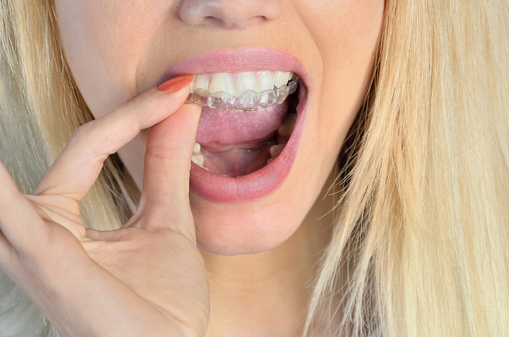 A lady taking out a retainer to clean it