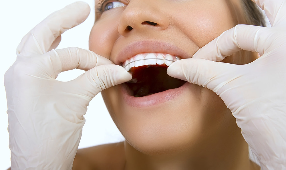 A lady having a dental retainer fitted