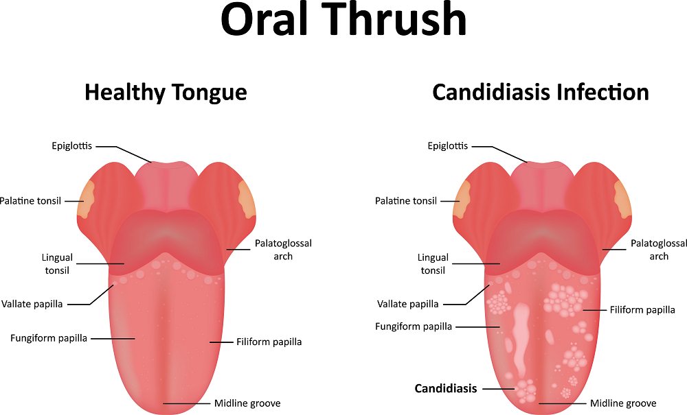 Health tongue compared to Candidiasis infection illustration