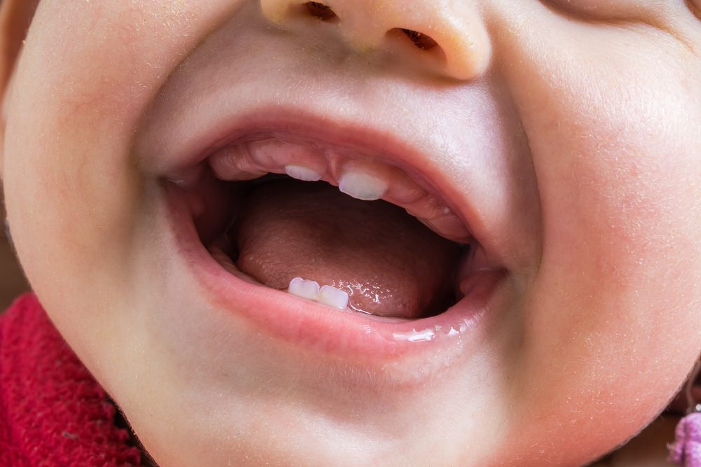 A baby showing their teeth coming through dental aware