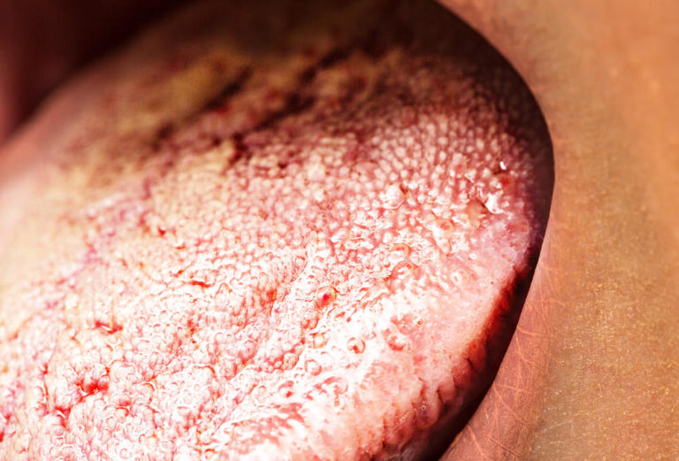 thrush candida candidiasis anug acute mesothelioma keynes gohealthygo adultes muguet dentalaware