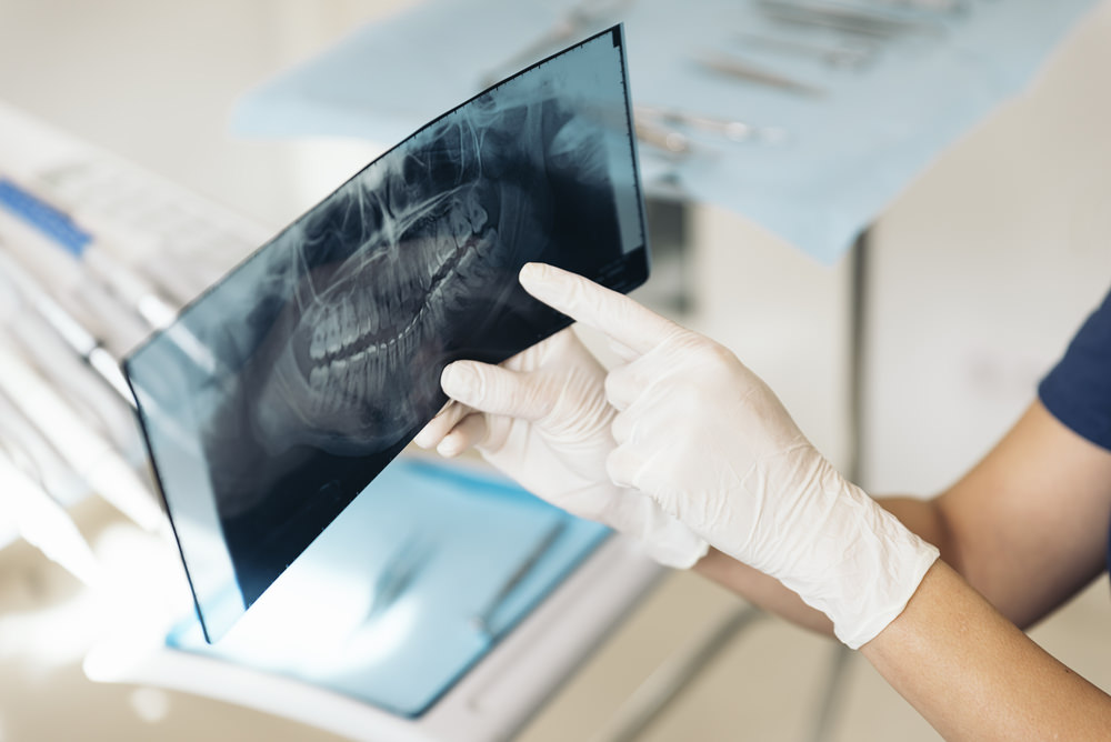 Are x-rays safe dental aware feature image