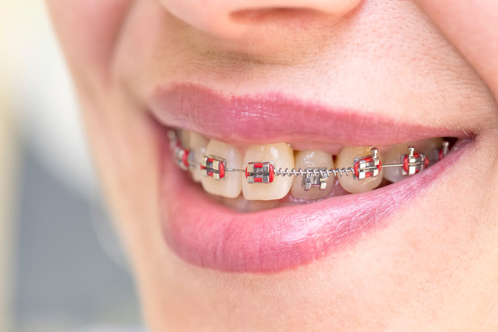 A woman with dental braces