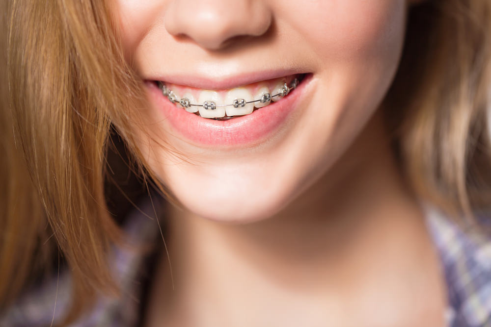 A girl with dental braces