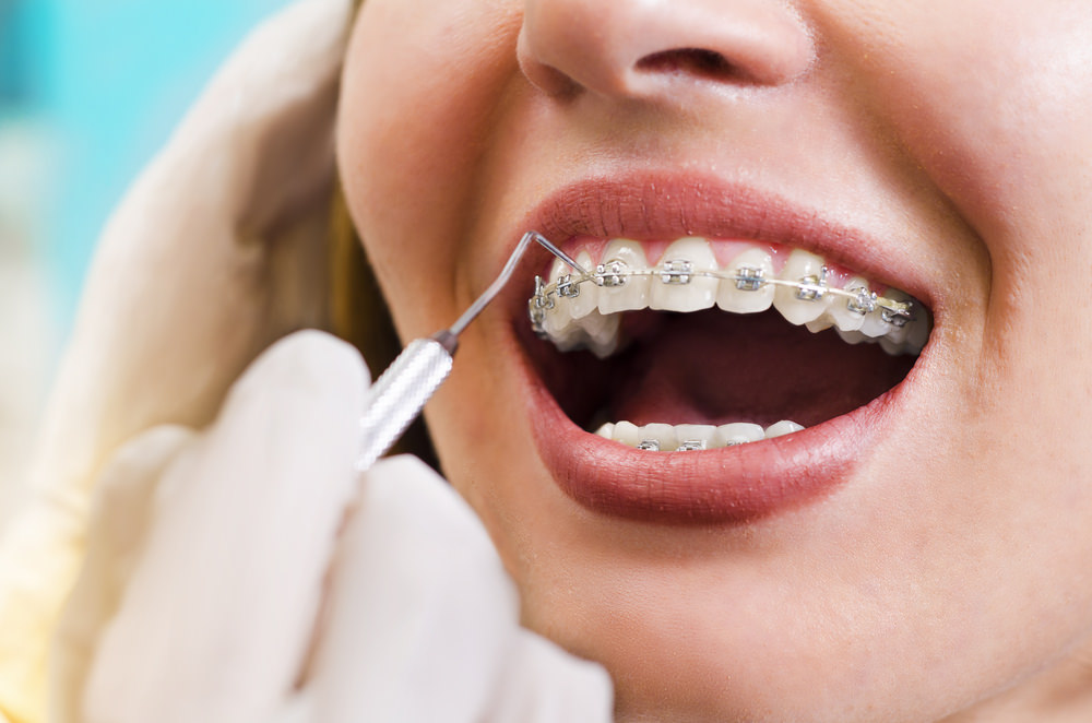 Braces Elastics – Must Read Guide!! - Dental Aware Australia