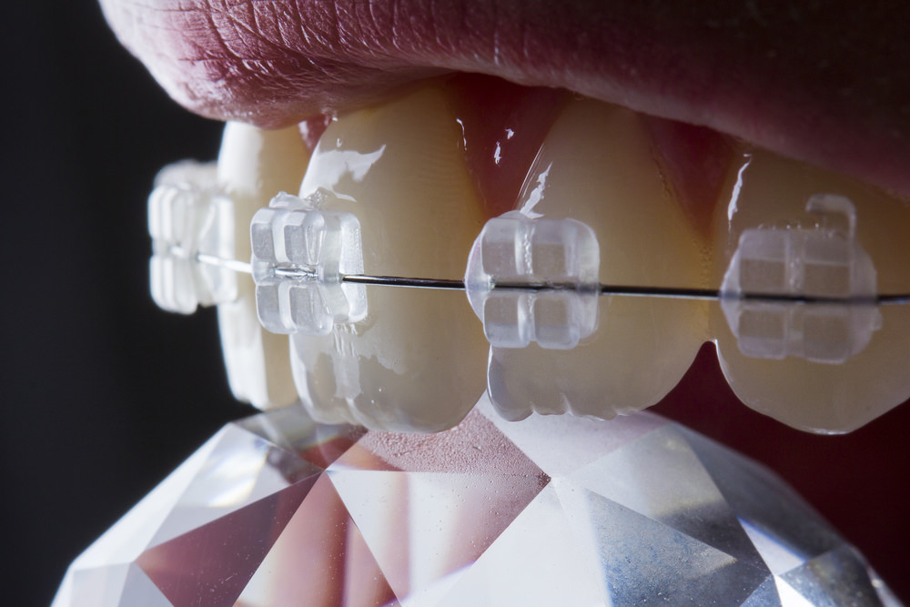 Braces colours feature dental aware