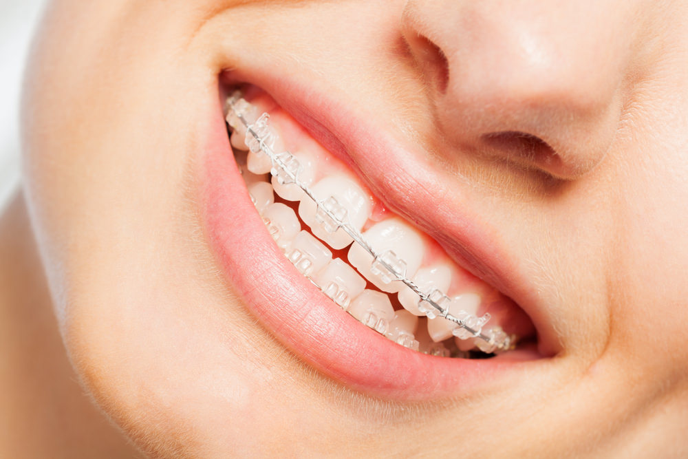 A lady smiling with braces