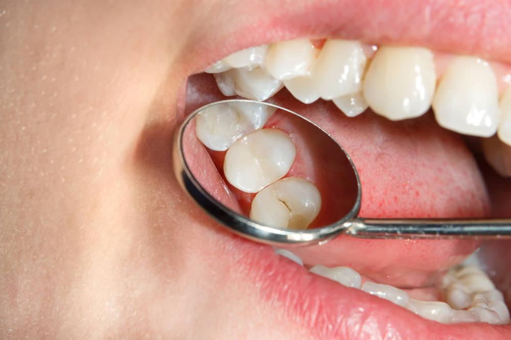 A dental mouth mirror